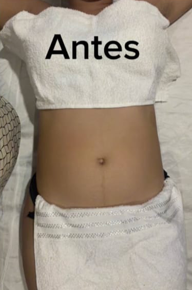 Antes